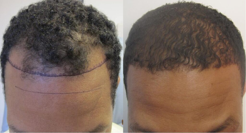 African American hair transplant -Who is the Right Candidate for African American Hair Transplant?